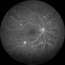 Augenhintergrund eines Diabetikers